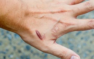 Sẹo lồi bị thâm đen phải làm sao? Nguyên nhân và cách khắc phục hiệu quả